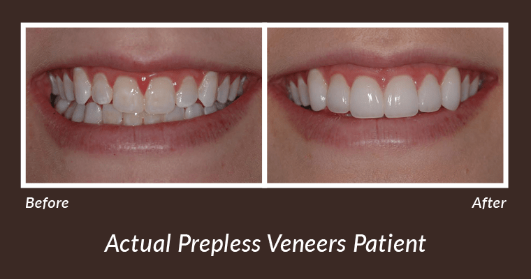 Before and after picture of patient with prepless veneer cosmetic treatment.