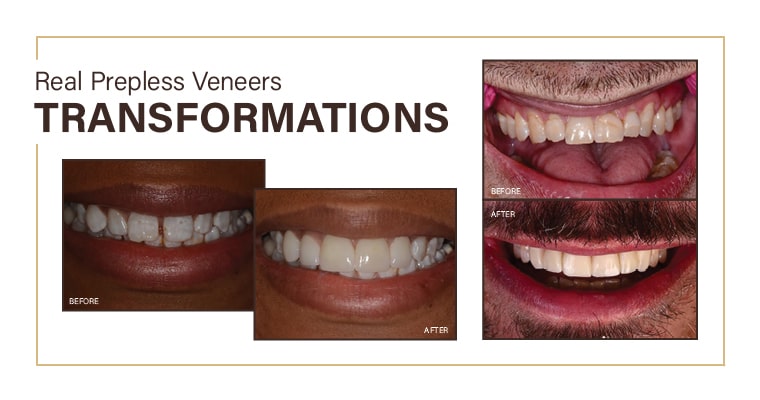 Image of patient’s before and after prepless veneers. 