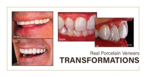 Before and after of real porcelain veneers on a patient.