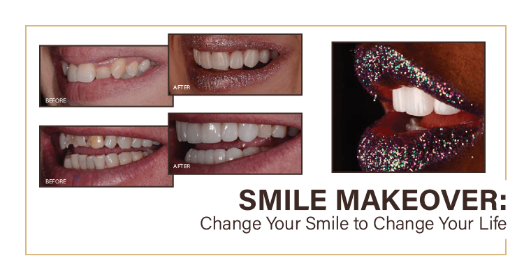 What Is a Smile Makeover?
